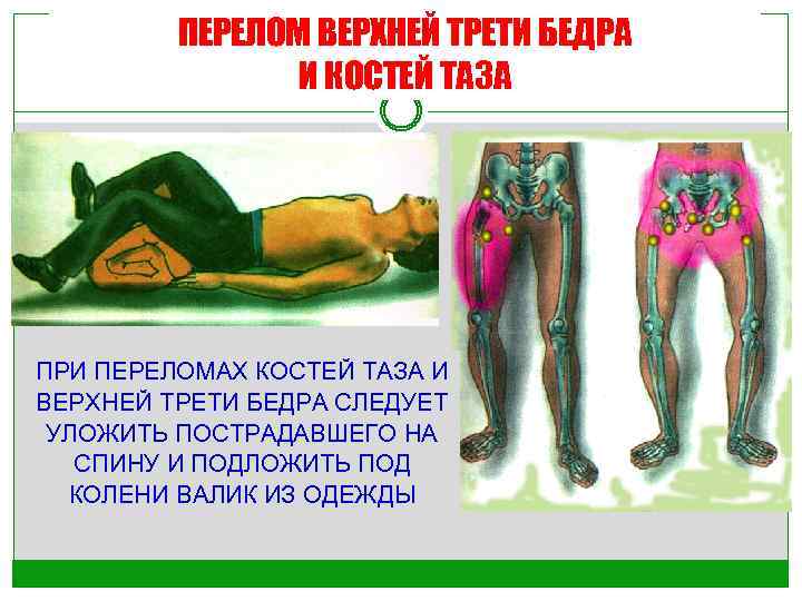 ПЕРЕЛОМ ВЕРХНЕЙ ТРЕТИ БЕДРА И КОСТЕЙ ТАЗА ПРИ ПЕРЕЛОМАХ КОСТЕЙ ТАЗА И ВЕРХНЕЙ ТРЕТИ