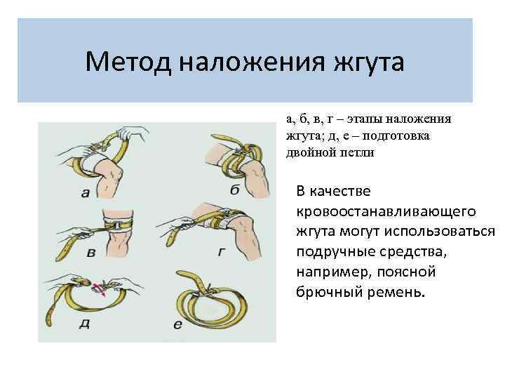 Метод наложения жгута а, б, в, г – этапы наложения жгута; д, е –