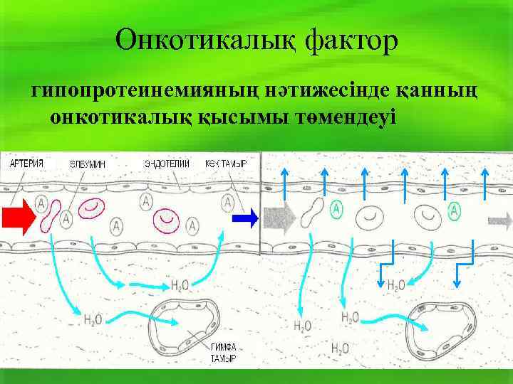 Онкотикалық фактор гипопротеинемияның нәтижесінде қанның онкотикалық қысымы төмендеуі 