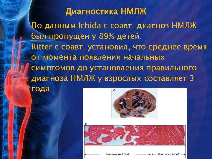 Диагностика НМЛЖ По данным Ichida с соавт. диагноз НМЛЖ был пропущен у 89% детей.