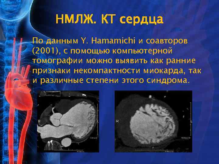 НМЛЖ. КТ сердца По данным Y. Hamamichi и соавторов (2001), с помощью компьютерной томографии