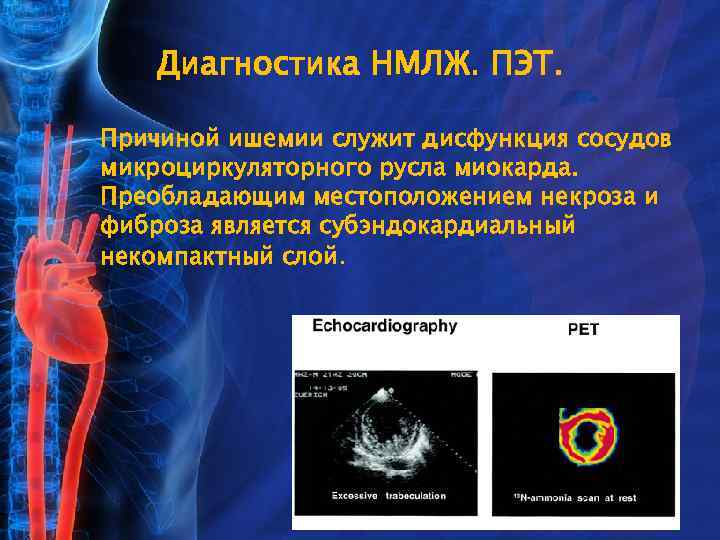 Диагностика НМЛЖ. ПЭТ. Причиной ишемии служит дисфункция сосудов микроциркуляторного русла миокарда. Преобладающим местоположением некроза