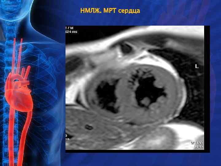 НМЛЖ. МРТ сердца 