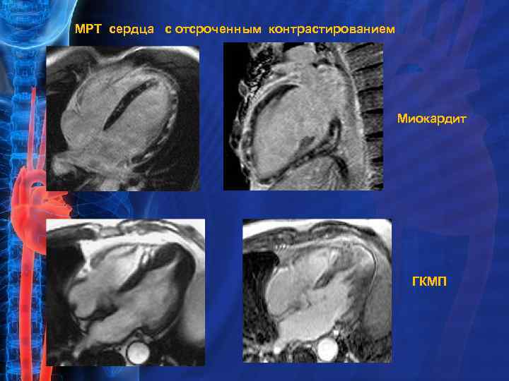 МРТ сердца с отсроченным контрастированием Миокардит ГКМП 