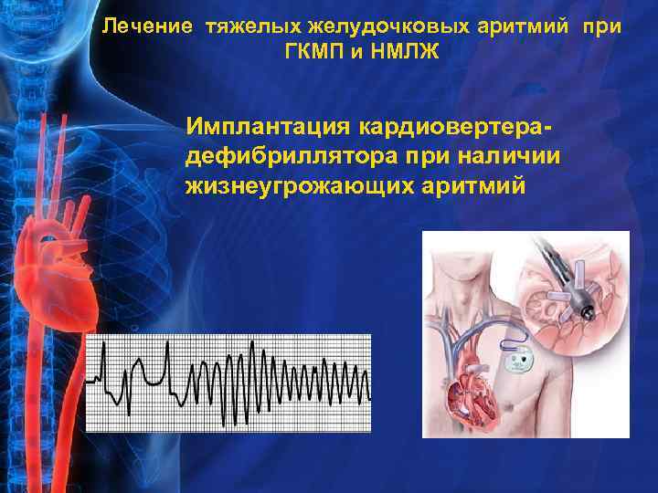 Лечение тяжелых желудочковых аритмий при ГКМП и НМЛЖ Имплантация кардиовертерадефибриллятора при наличии жизнеугрожающих аритмий