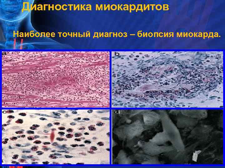 Диагностика миокардитов Наиболее точный диагноз – биопсия миокарда. 