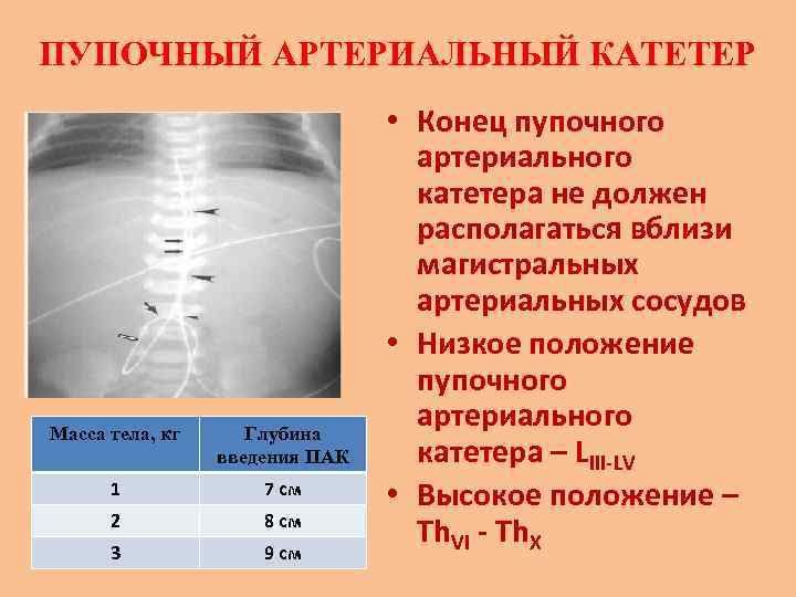 Катетер пупочный фото