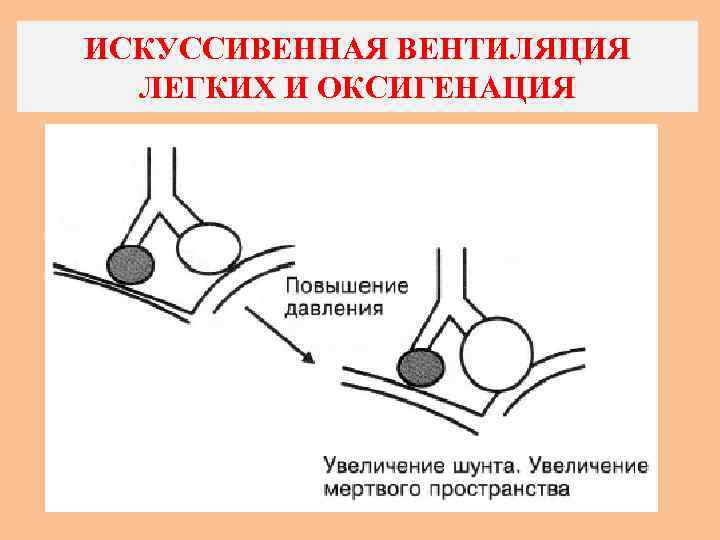 ИСКУССИВЕННАЯ ВЕНТИЛЯЦИЯ ЛЕГКИХ И ОКСИГЕНАЦИЯ 