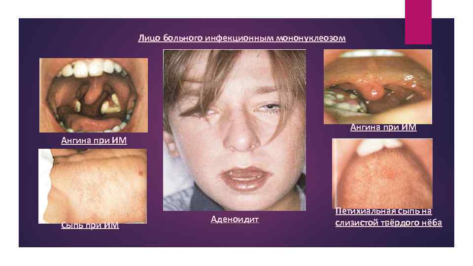 Лицо больного инфекционным мононуклеозом Ангина при ИМ Сыпь при ИМ Аденоидит Петихиальная сыпь на
