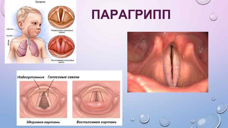 ПАРАГРИПП 