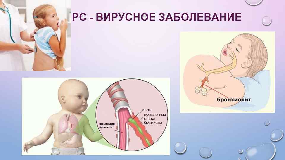 РС - ВИРУСНОЕ ЗАБОЛЕВАНИЕ 