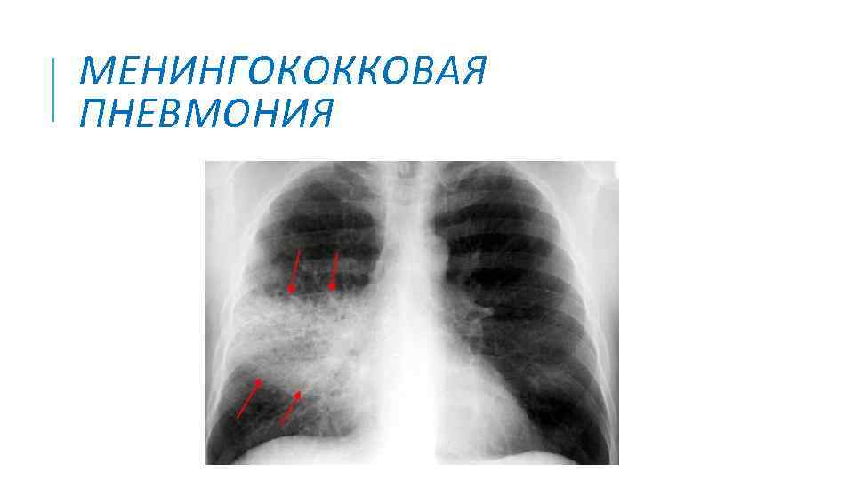 МЕНИНГОКОККОВАЯ ПНЕВМОНИЯ 