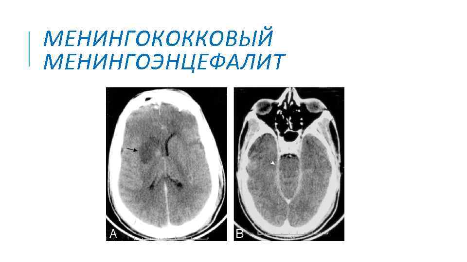 МЕНИНГОКОККОВЫЙ МЕНИНГОЭНЦЕФАЛИТ 