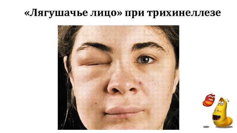  «Лягушачье лицо» при трихинеллезе 