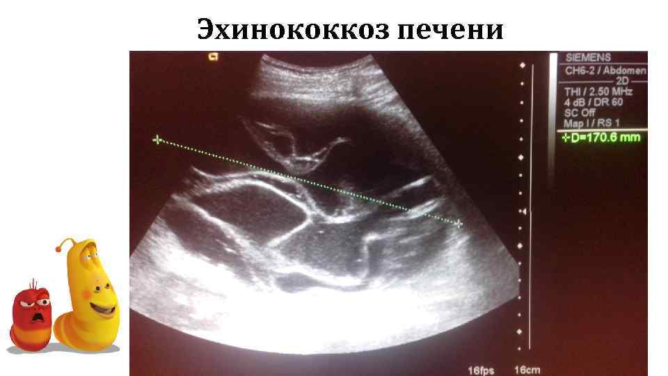 Эхинококкоз печени 