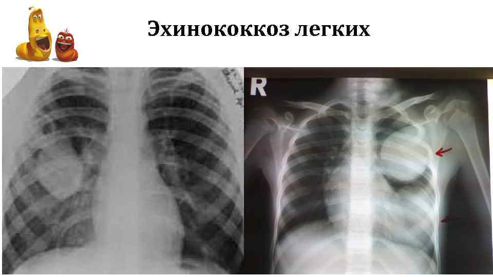 Эхинококкоз легких 