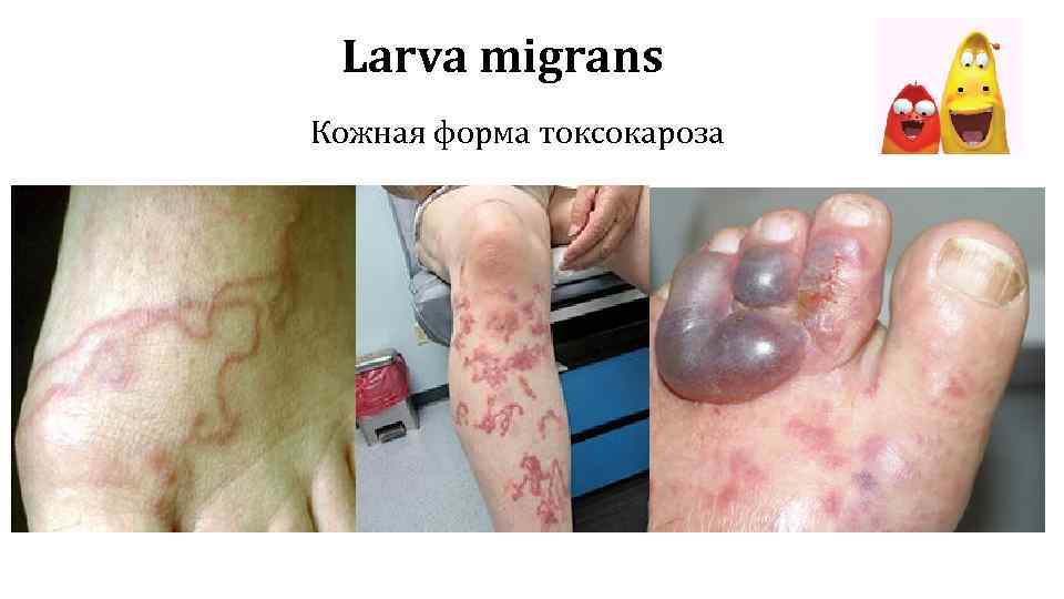 Larva migrans Кожная форма токсокароза 