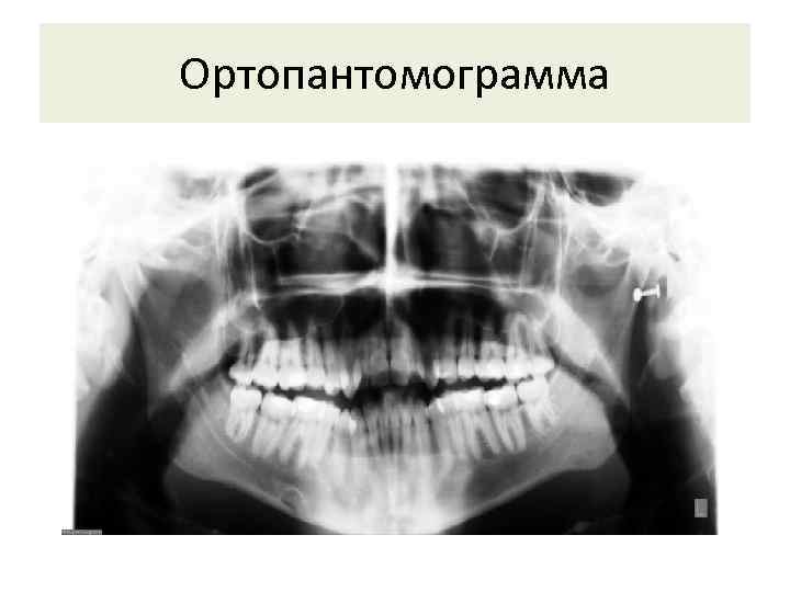 Схема описания ортопантомограммы