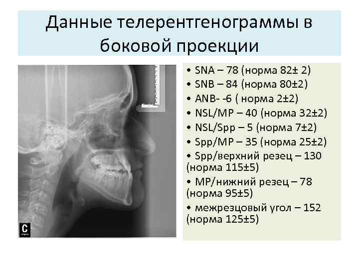 Данные телерентгенограммы в боковой проекции • SNA – 78 (норма 82± 2) • SNB