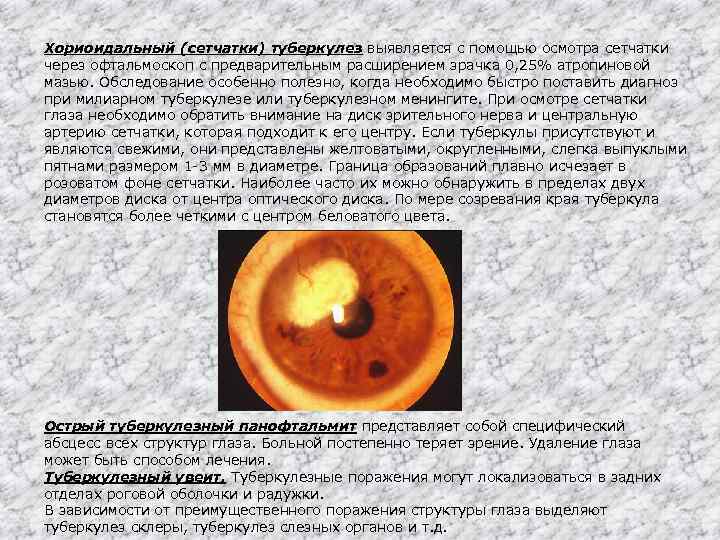 Хориоидальный (сетчатки) туберкулез выявляется с помощью осмотра сетчатки через офтальмоскоп с предварительным расширением зрачка