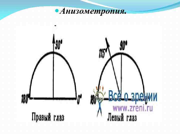  Анизометропия. 