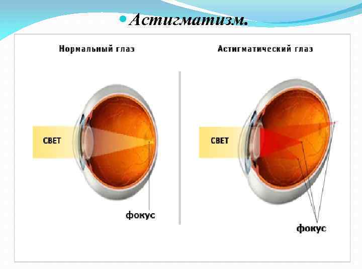  Астигматизм. 