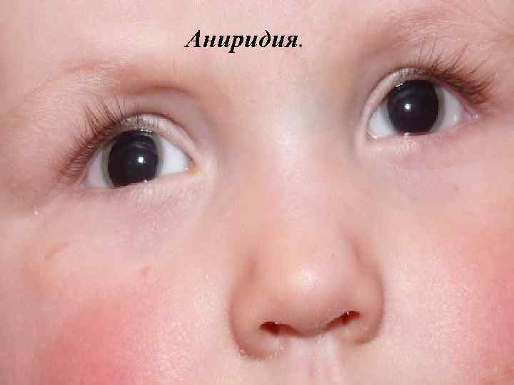 Аниридия. 
