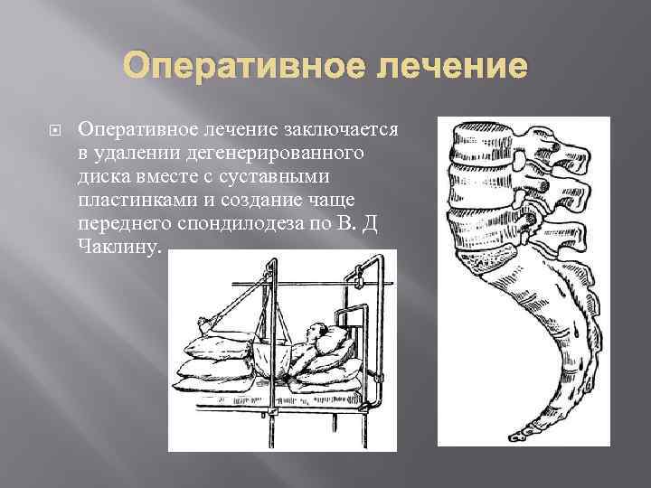 Оперативное лечение заключается в удалении дегенерированного диска вместе с суставными пластинками и создание чаще