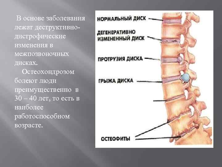 Поясничный остеохондроз код