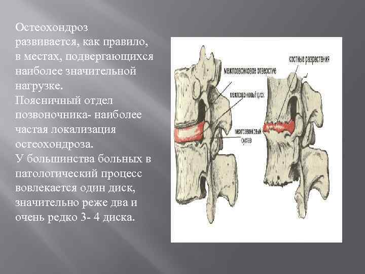 Остеохондроз развивается, как правило, в местах, подвергающихся наиболее значительной нагрузке. Поясничный отдел позвоночника- наиболее