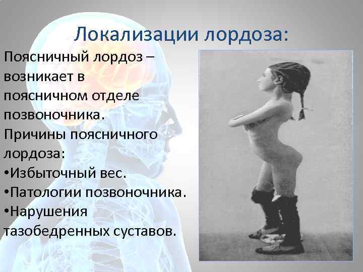 Локализации лордоза: Поясничный лордоз – возникает в поясничном отделе позвоночника. Причины поясничного лордоза: •