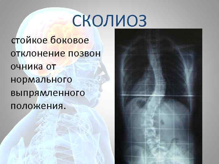 СКОЛИОЗ стойкое боковое отклонение позвон очника от нормального выпрямленного положения. 