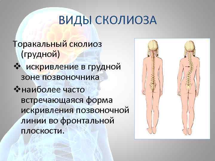 ВИДЫ СКОЛИОЗА Торакальный сколиоз (грудной) v искривление в грудной зоне позвоночника vнаиболее часто встречающаяся