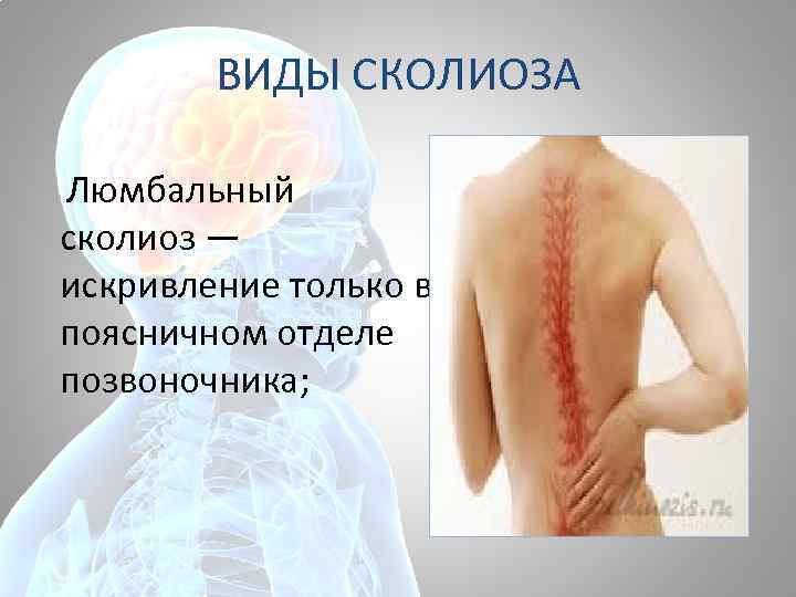 ВИДЫ СКОЛИОЗА Люмбальный сколиоз — искривление только в поясничном отделе позвоночника; 