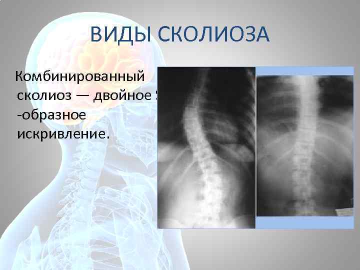 ВИДЫ СКОЛИОЗА Комбинированный сколиоз — двойное S -образное искривление. 