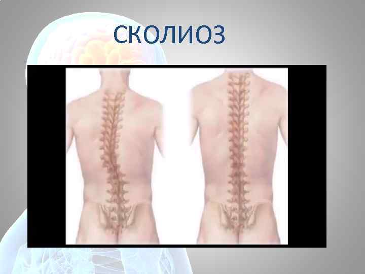 СКОЛИОЗ 