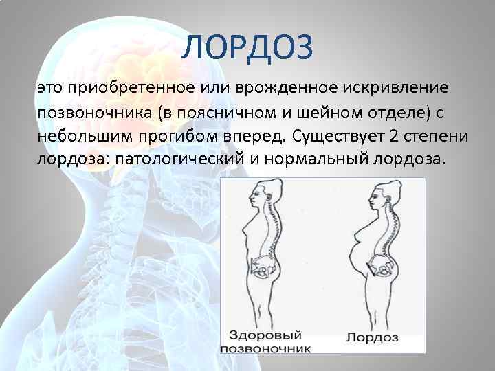 ЛОРДОЗ это приобретенное или врожденное искривление позвоночника (в поясничном и шейном отделе) с небольшим