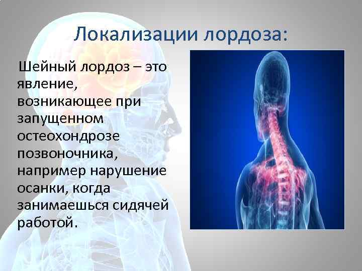 Локализации лордоза: Шейный лордоз – это явление, возникающее при запущенном остеохондрозе позвоночника, например нарушение