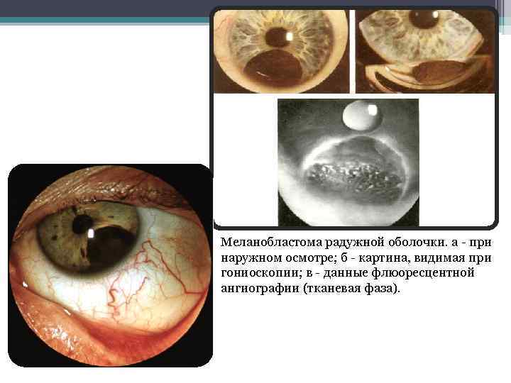 Меланобластома радужной оболочки. а - при наружном осмотре; б - картина, видимая при гониоскопии;