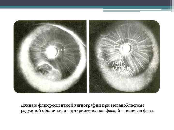 Данные флюоресцентной ангиографии при меланобластоме радужной оболочки. а - артериовенозная фаза; б - тканевая