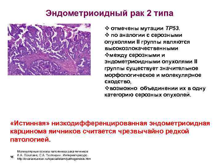      Эндометриоидный рак 2 типа     