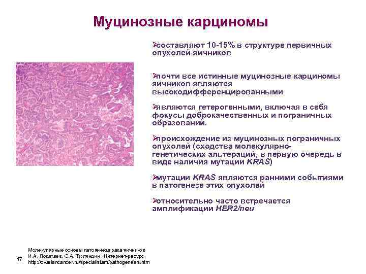 Муцинозные опухоли яичников