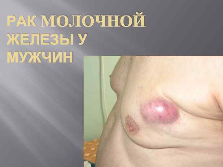РАК МОЛОЧНОЙ ЖЕЛЕЗЫ У МУЖЧИН 