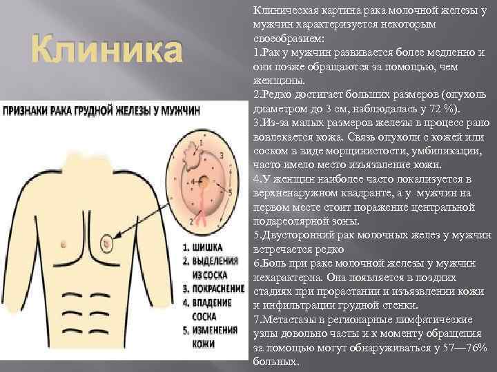    Клиническая картина рака молочной железы у  мужчин характеризуется некоторым Клиника