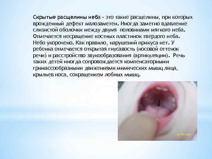 Скрытые расщелины неба - это такие расщелины, при которых врожденный дефект малозаметен. Иногда заметно
