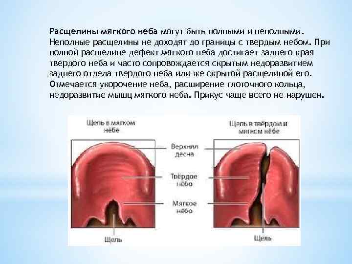Расщелины мягкого неба могут быть полными и неполными. Неполные расщелины не доходят до границы