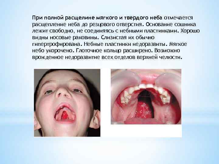 При полной расщелине мягкого и твердого неба отмечается расщепление неба до резцового отверстия. Основание