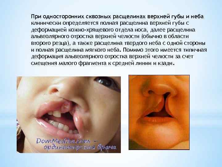 При односторонних сквозных расщелинах верхней губы и неба клинически определяется полная расщелина верхней губы