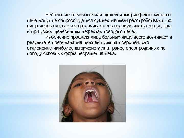   Небольшие (точечные или щелевидные) дефекты мягкого нёба могут не сопровождаться субъективными расстройствами,