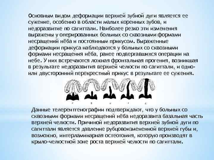 Основным видом деформации верхней зубной дуги является ее сужение, особенно в области малых коренных
